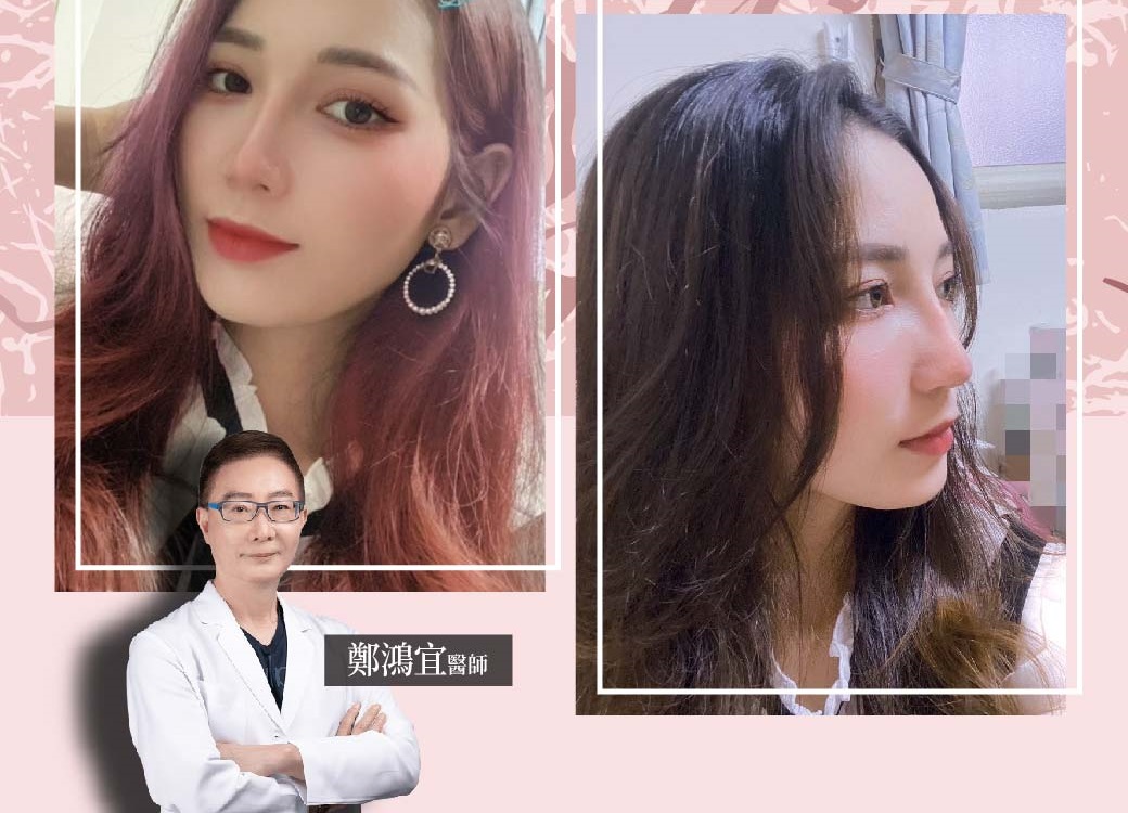 鼻部整形/隆鼻重建/鼻形雕塑